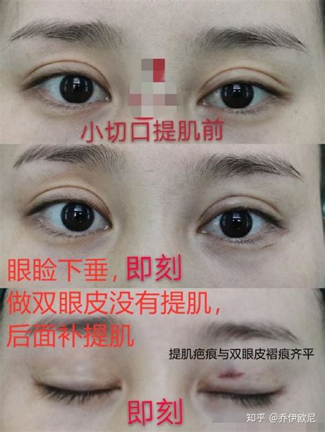 割双眼皮能喝酒吗