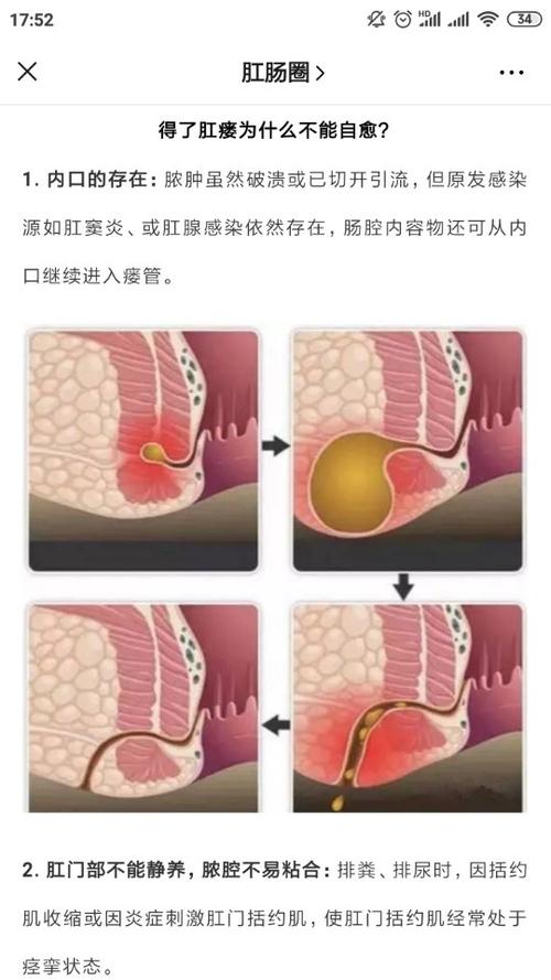 肛瘘康复后能喝啤酒吗