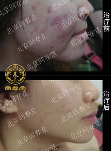 怎样治脸上的痤疮
