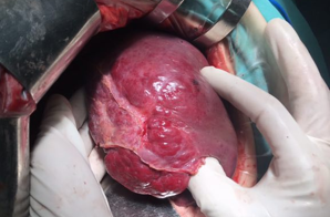 肝脏海绵状血管瘤严重吗